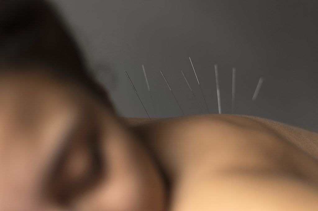 ACUPUNCTURE TREATMENT IN QUEENS AND BROOKLYN, NY​